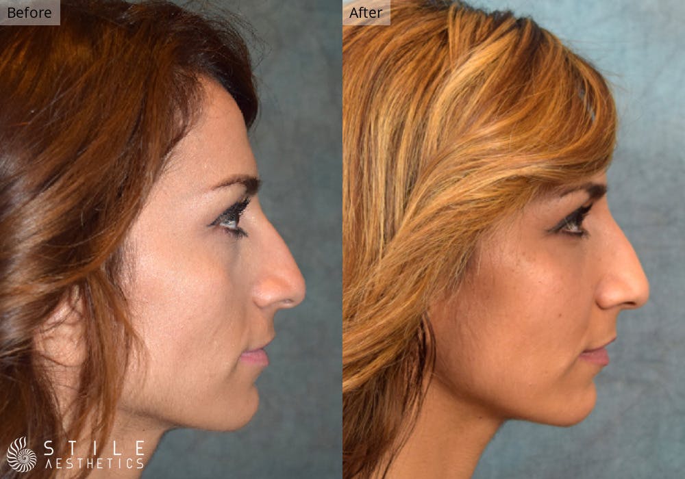 Facial Fat Transfer Before & After Gallery - Patient 158991 - Image 2