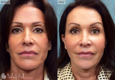 Facial Fat Transfer Before & After Gallery - Patient 265814 - Image 1