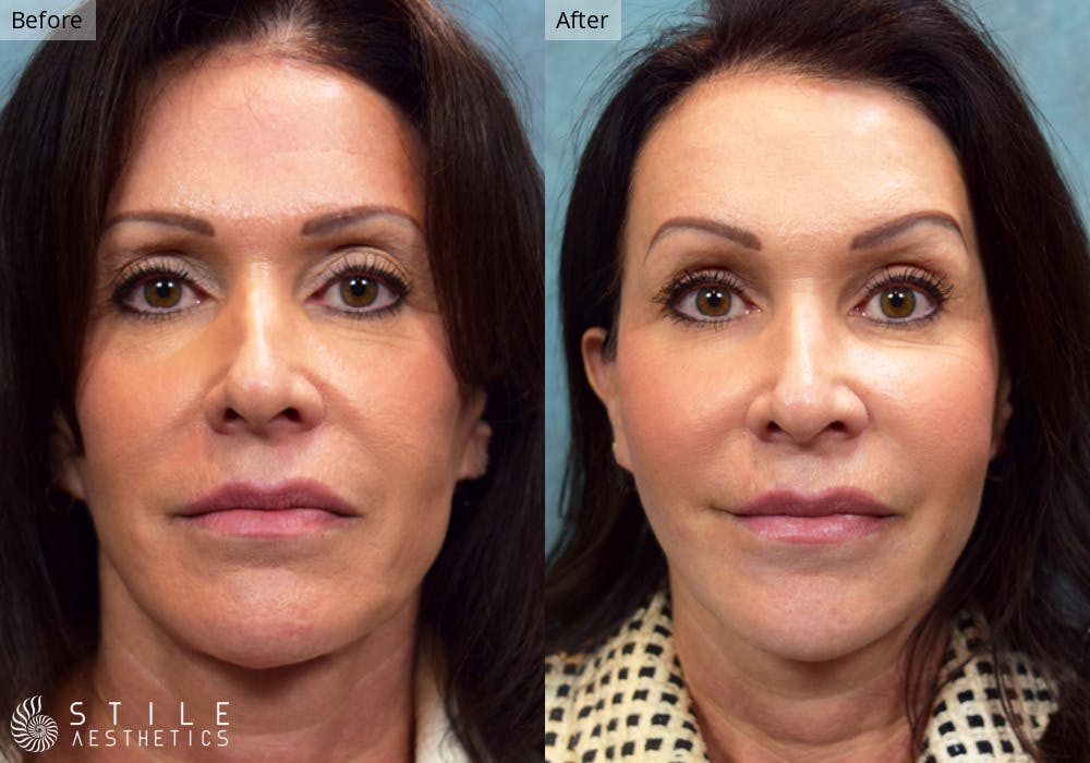 Facial Fat Transfer Before & After Gallery - Patient 265814 - Image 1