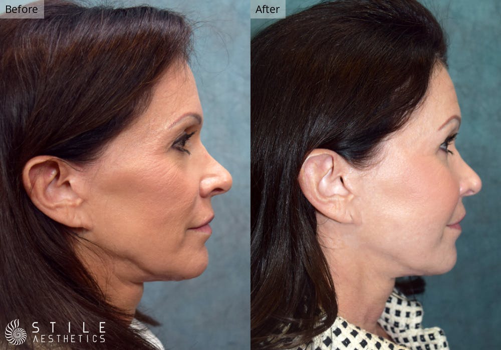 Facial Fat Transfer Before & After Gallery - Patient 265814 - Image 2