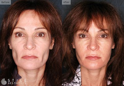 Facial Fat Transfer Before & After Gallery - Patient 105812 - Image 1