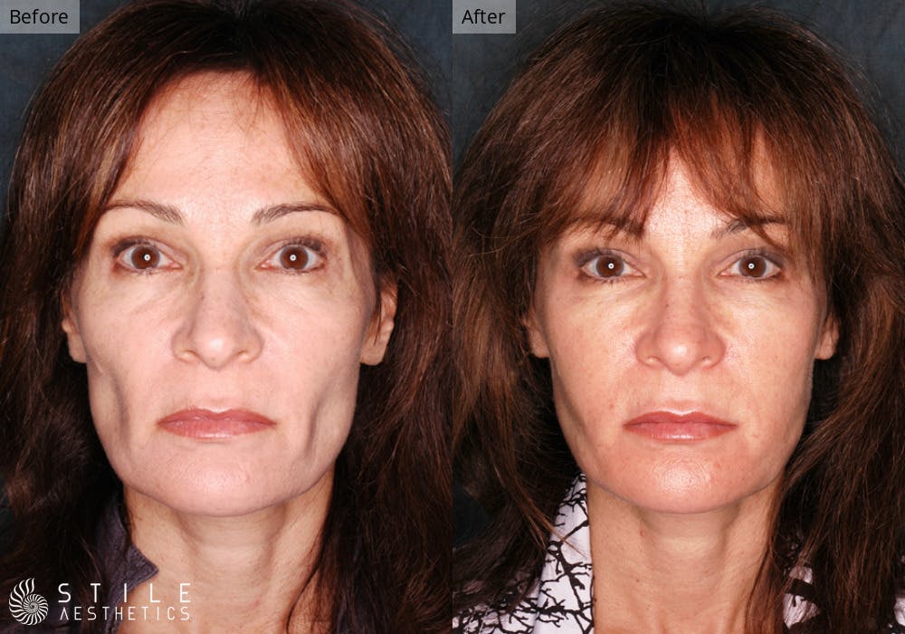 Facial Fat Transfer Before & After Gallery - Patient 105812 - Image 1