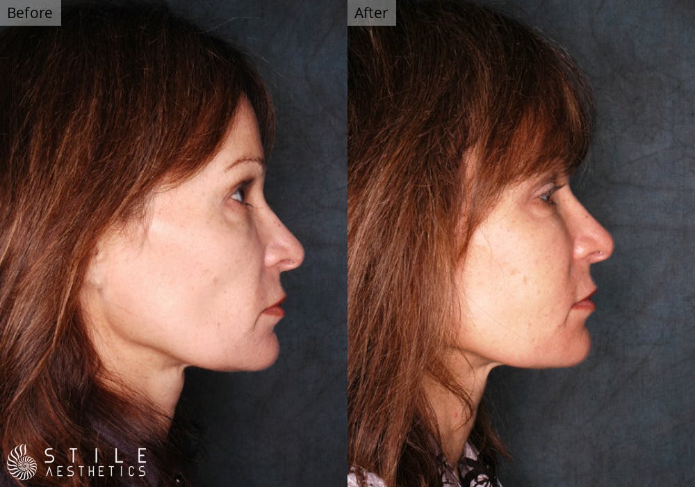 Facial Fat Transfer Before & After Gallery - Patient 105812 - Image 2