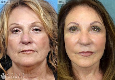 Facial Fat Transfer Before & After Gallery - Patient 772923 - Image 1