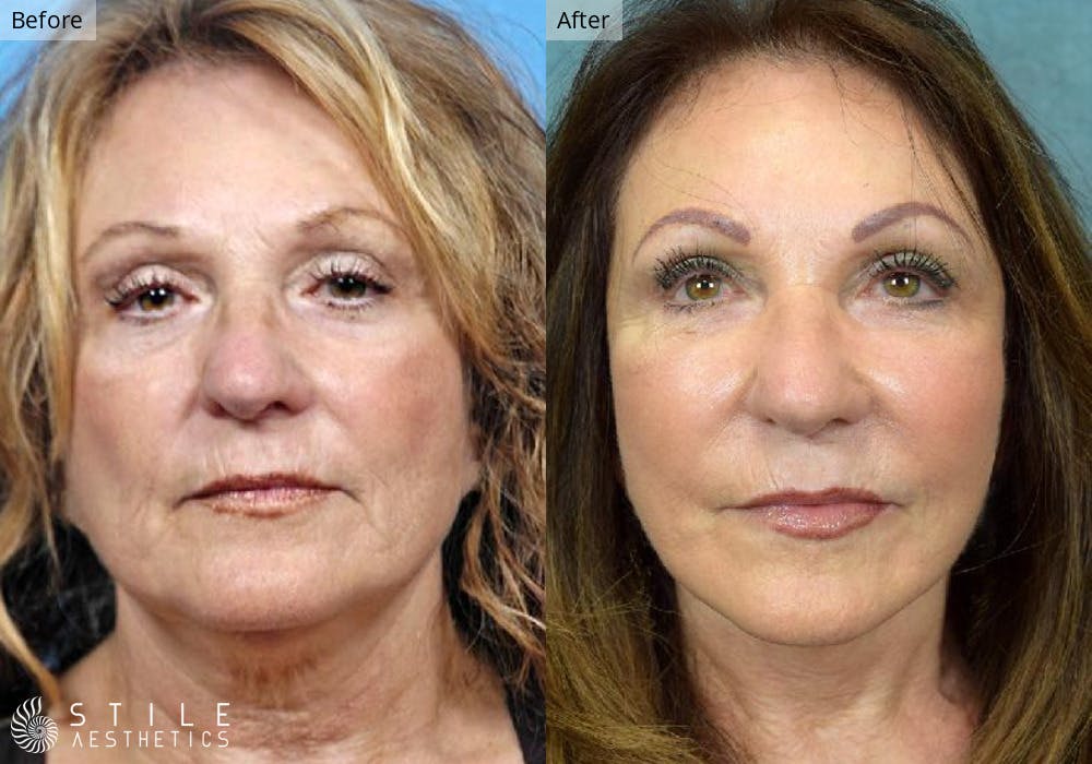 Facial Fat Transfer Before & After Gallery - Patient 772923 - Image 1