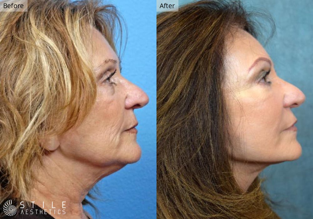 Facial Fat Transfer Before & After Gallery - Patient 772923 - Image 2