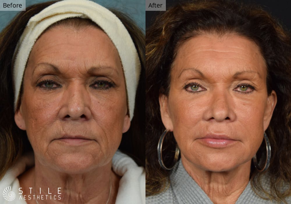 Facial Fat Transfer Before & After Gallery - Patient 133169 - Image 1