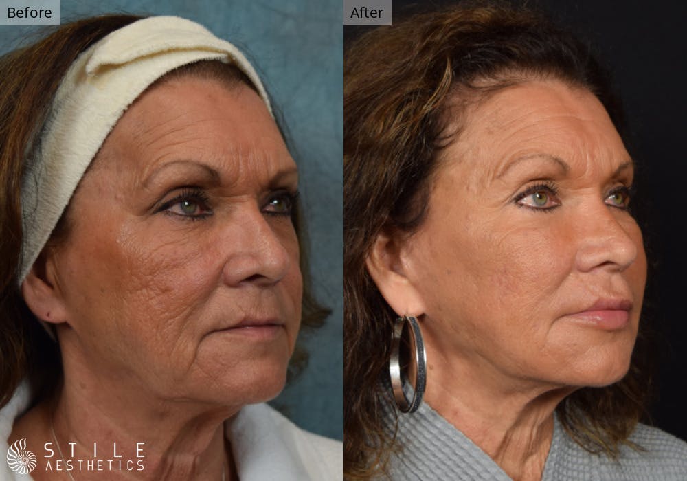 Facial Fat Transfer Before & After Gallery - Patient 133169 - Image 2