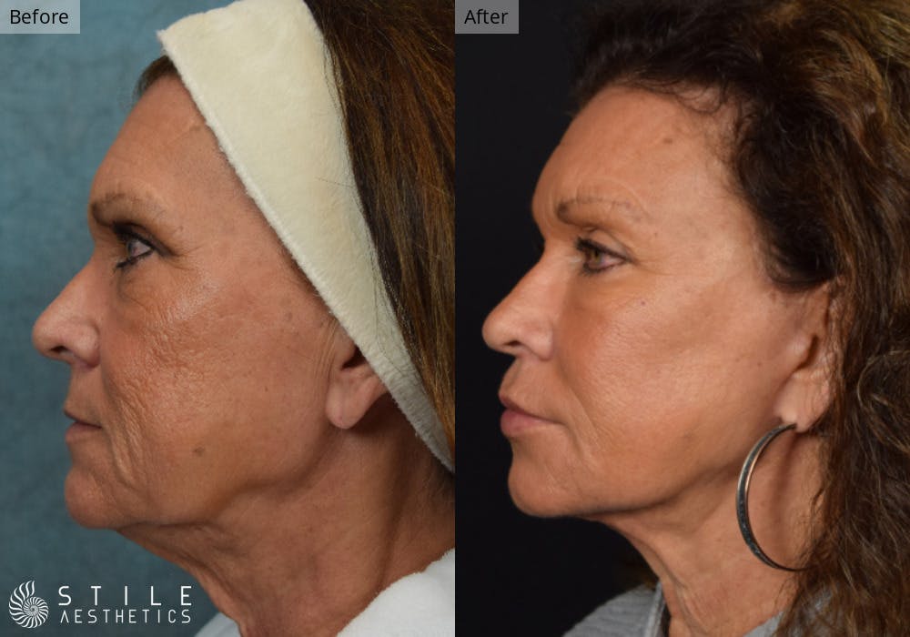 Facial Fat Transfer Before & After Gallery - Patient 133169 - Image 3