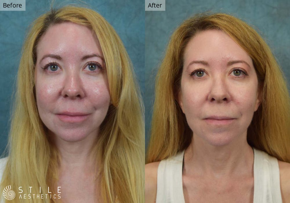 Facial Fat Transfer Before & After Gallery - Patient 395294 - Image 1