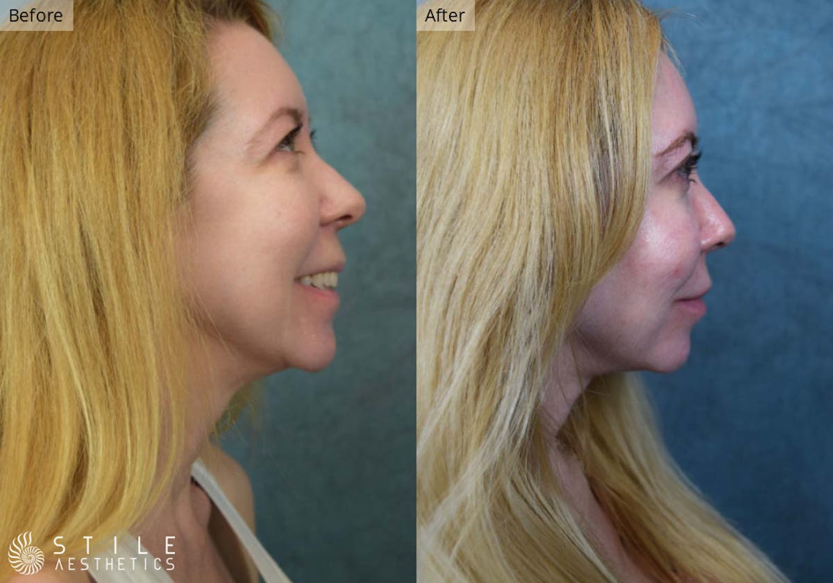Facial Fat Transfer Before & After Gallery - Patient 395294 - Image 2