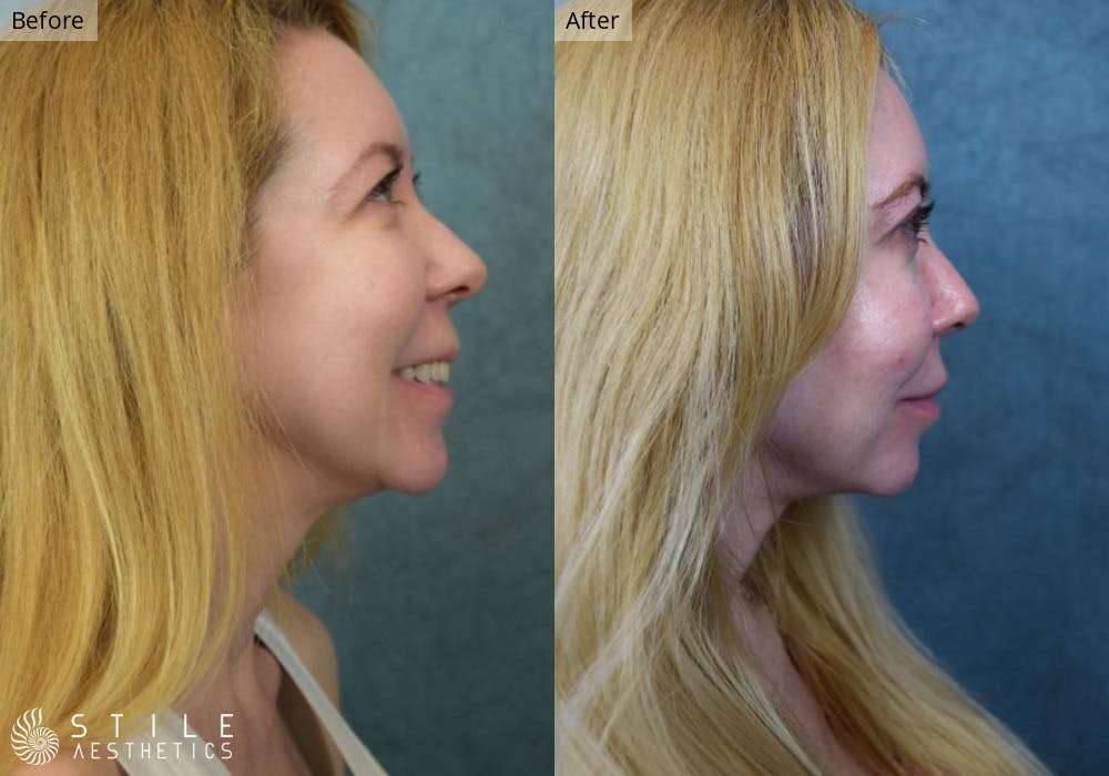 Facial Fat Transfer Before & After Gallery - Patient 395294 - Image 2