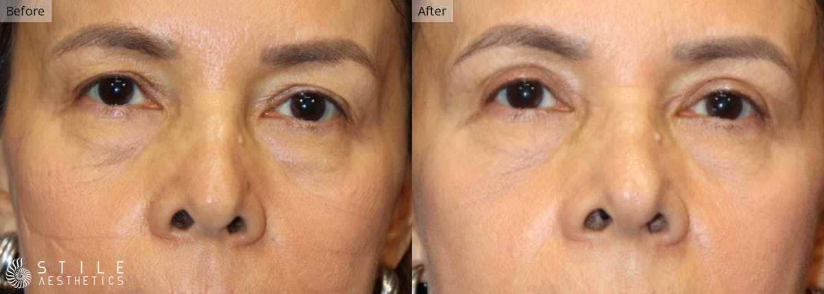 Upper Eyelid Surgery Before & After Gallery - Patient 118140 - Image 1