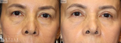 Upper Eyelid Surgery Before & After Gallery - Patient 118140 - Image 1
