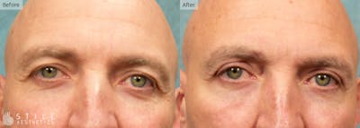 Upper Eyelid Surgery Before & After Gallery - Patient 941472 - Image 1