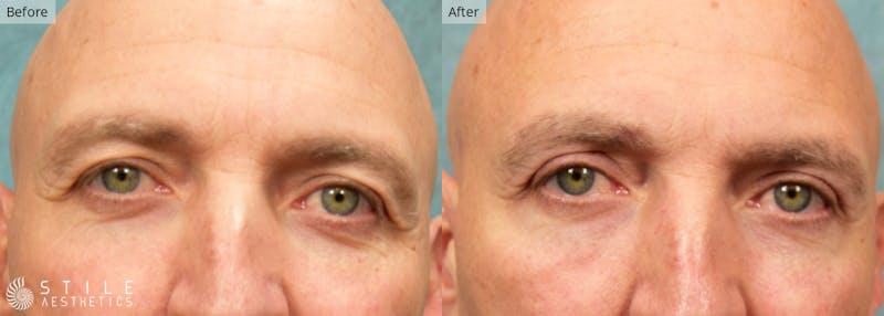 Upper Eyelid Surgery Before & After Gallery - Patient 941472 - Image 1
