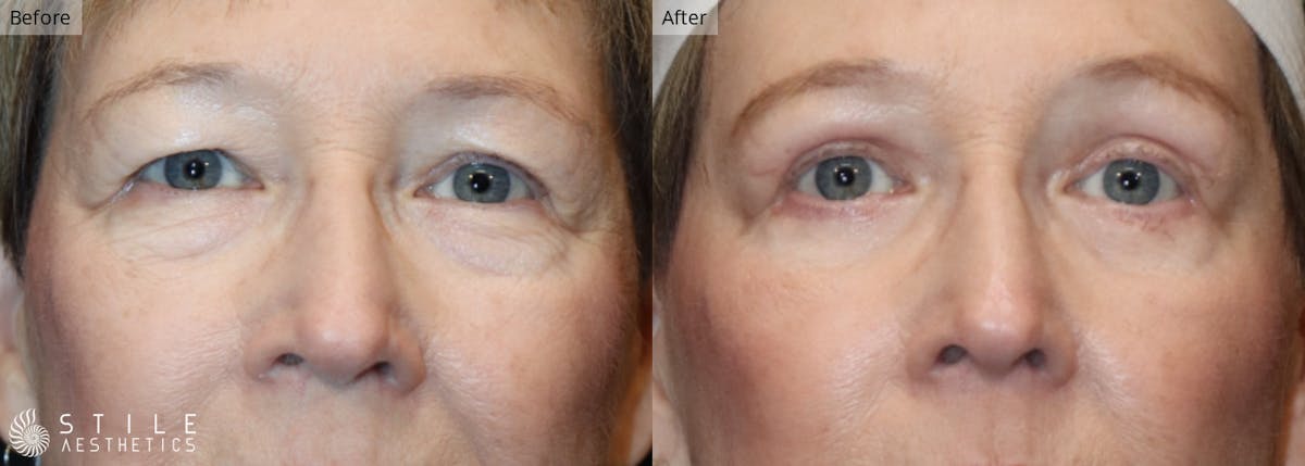 Upper Eyelid Surgery Before & After Gallery - Patient 330427 - Image 1