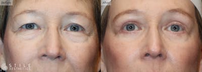 Upper Eyelid Surgery Before & After Gallery - Patient 330427 - Image 1