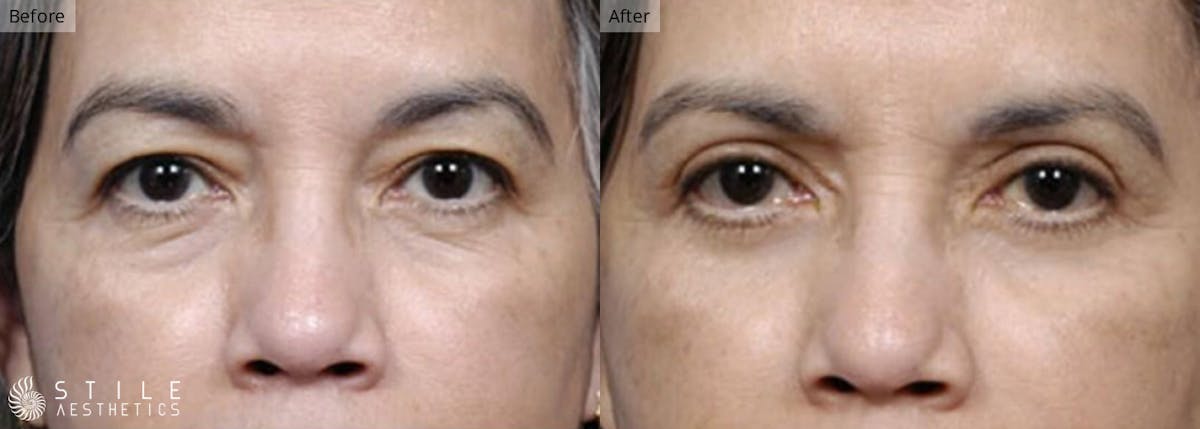 Upper Eyelid Surgery Before & After Gallery - Patient 182657 - Image 1