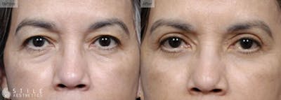 Upper Eyelid Surgery Before & After Gallery - Patient 182657 - Image 1