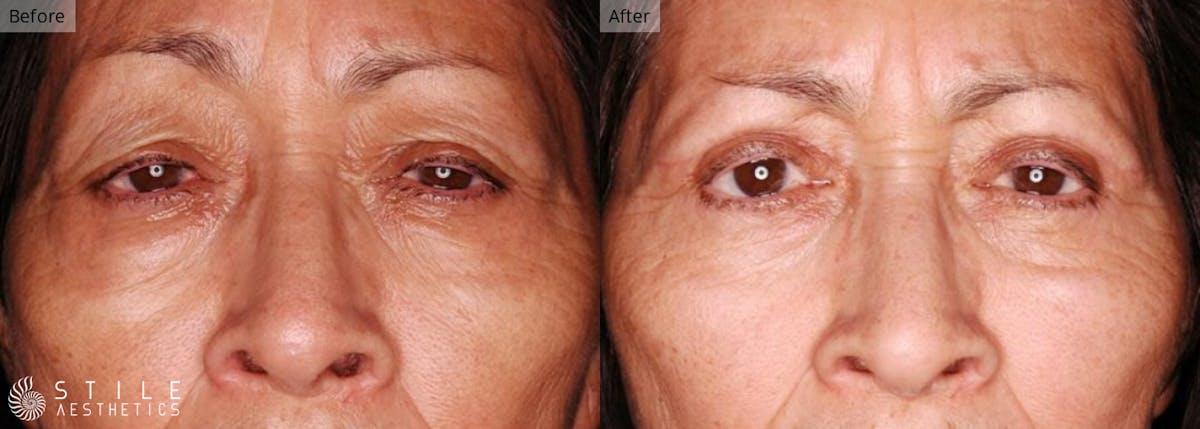 Upper Eyelid Surgery Before & After Gallery - Patient 260199 - Image 1