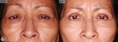 Upper Eyelid Surgery Before & After Gallery - Patient 260199 - Image 1
