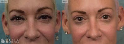 Upper Eyelid Surgery Before & After Gallery - Patient 607616 - Image 1