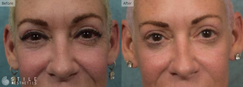 Upper Eyelid Surgery Before & After Gallery - Patient 607616 - Image 1