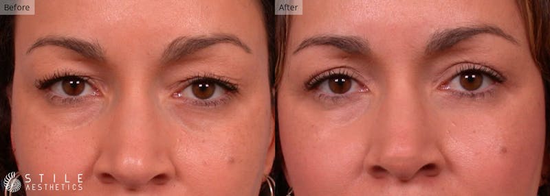 Upper Eyelid Surgery Before & After Gallery - Patient 939032 - Image 1