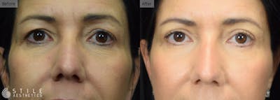 Upper Eyelid Surgery Before & After Gallery - Patient 140542 - Image 1