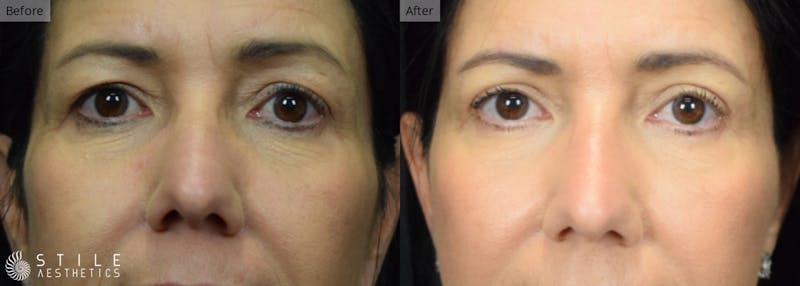Upper Eyelid Surgery Before & After Gallery - Patient 140542 - Image 1