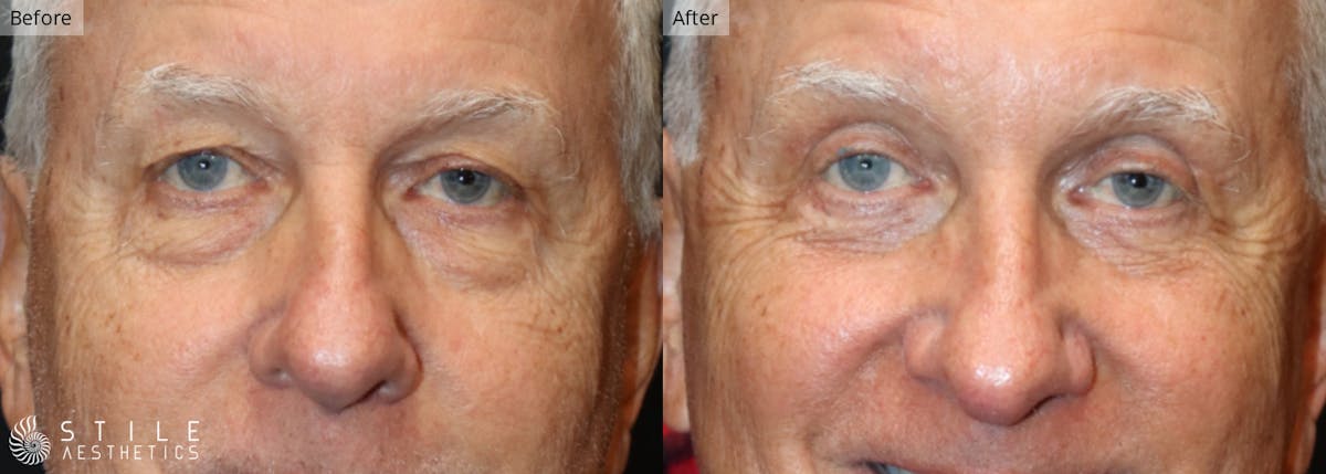 Upper Eyelid Surgery Before & After Gallery - Patient 164762 - Image 1