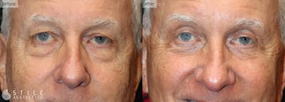 Upper Eyelid Surgery Before & After Gallery - Patient 164762 - Image 1