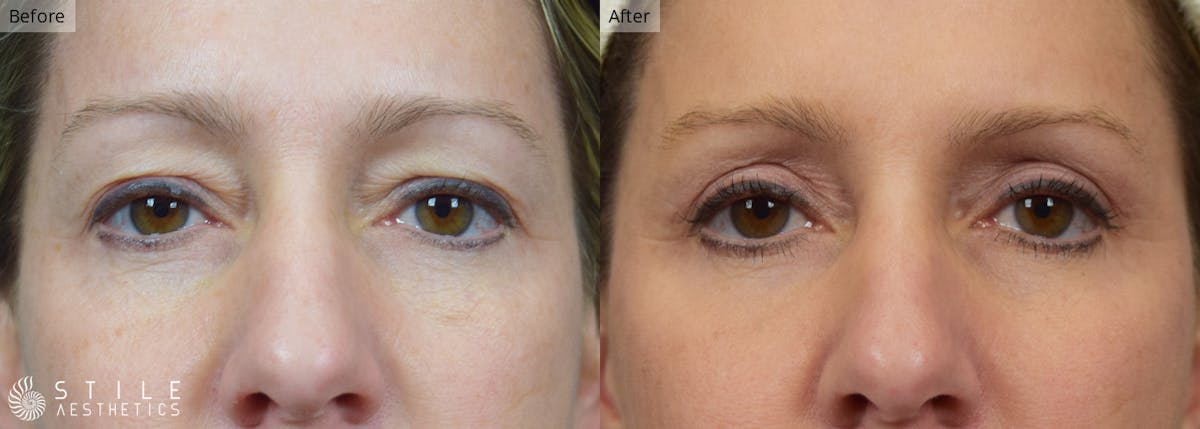 Upper Eyelid Surgery Before & After Gallery - Patient 241496 - Image 1