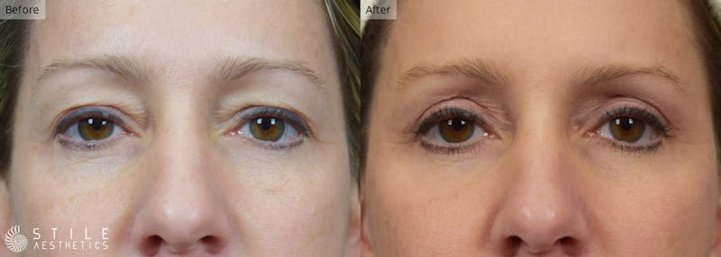 Upper Eyelid Surgery Before & After Gallery - Patient 241496 - Image 1