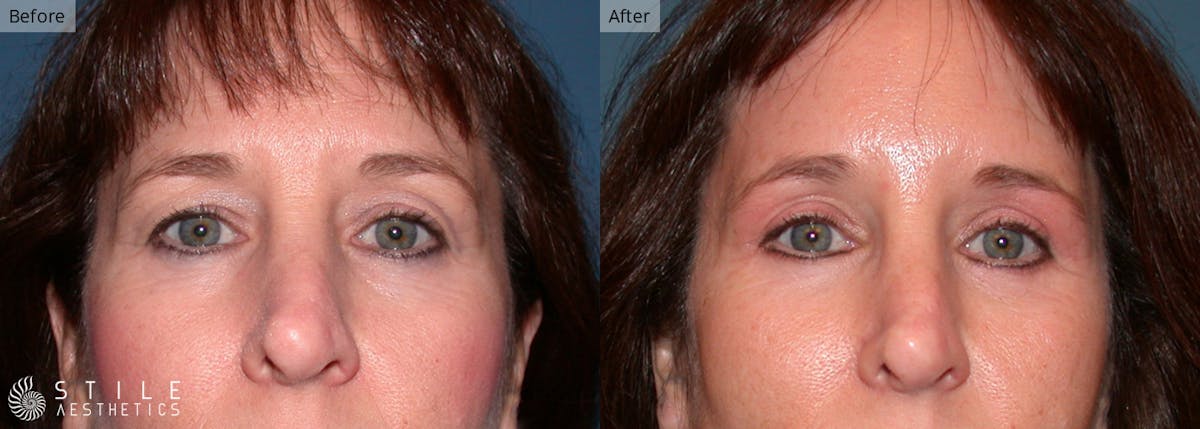 Upper Eyelid Surgery Before & After Gallery - Patient 107354 - Image 1