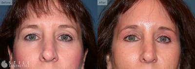 Upper Eyelid Surgery Before & After Gallery - Patient 107354 - Image 1