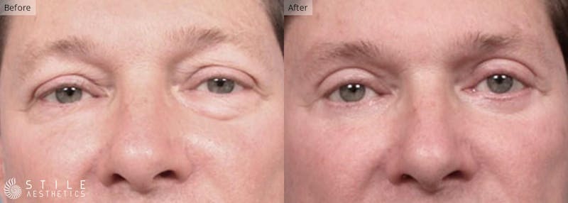 Upper Eyelid Surgery Before & After Gallery - Patient 264792 - Image 1