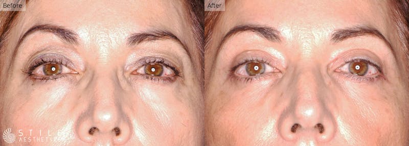 Upper Eyelid Surgery Before & After Gallery - Patient 142666 - Image 1