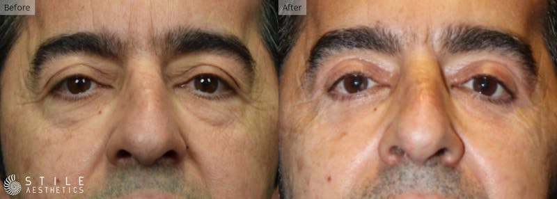 Upper Eyelid Surgery Before & After Gallery - Patient 152224 - Image 1