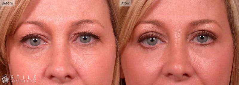 Upper Eyelid Surgery Before & After Gallery - Patient 312150 - Image 1