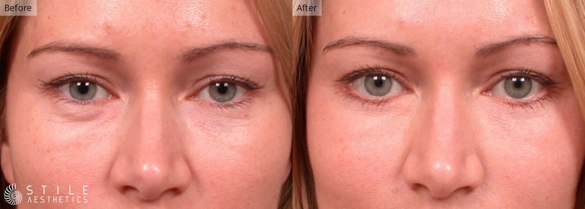 Lower Eyelid Surgery Before & After Gallery - Patient 106632 - Image 1