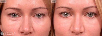 Lower Eyelid Surgery Before & After Gallery - Patient 106632 - Image 1