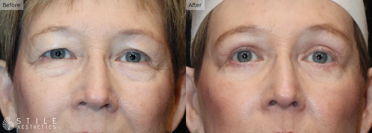 Lower Eyelid Surgery Before & After Gallery - Patient 144531 - Image 1
