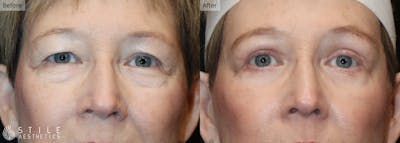 Lower Eyelid Surgery Before & After Gallery - Patient 144531 - Image 1