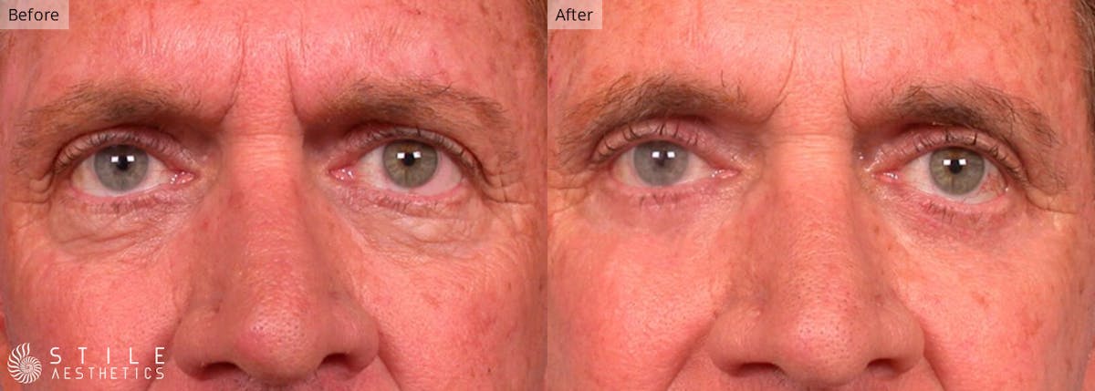 Lower Eyelid Surgery Before & After Gallery - Patient 226138 - Image 1