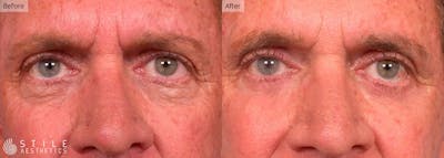Lower Eyelid Surgery Before & After Gallery - Patient 226138 - Image 1
