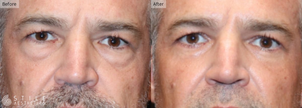 Lower Eyelid Surgery Before & After Gallery - Patient 329540 - Image 1