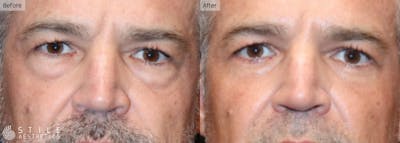 Lower Eyelid Surgery Before & After Gallery - Patient 329540 - Image 1