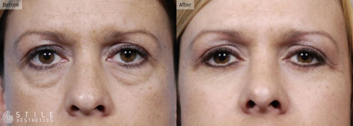 Lower Eyelid Surgery Before & After Gallery - Patient 238819 - Image 1